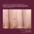 Solasculp™ ContourBand