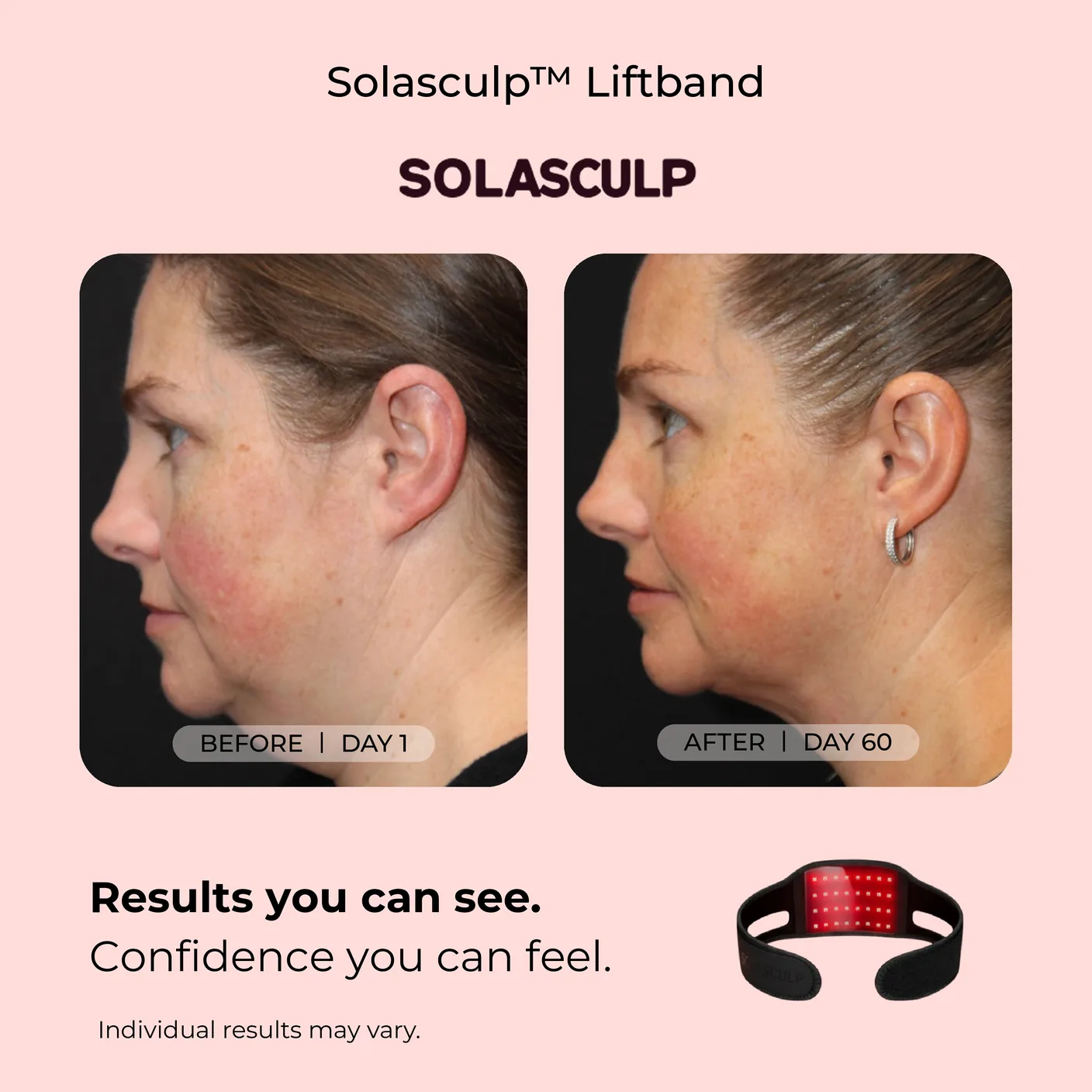 Jawline, Day 1 and Day 60